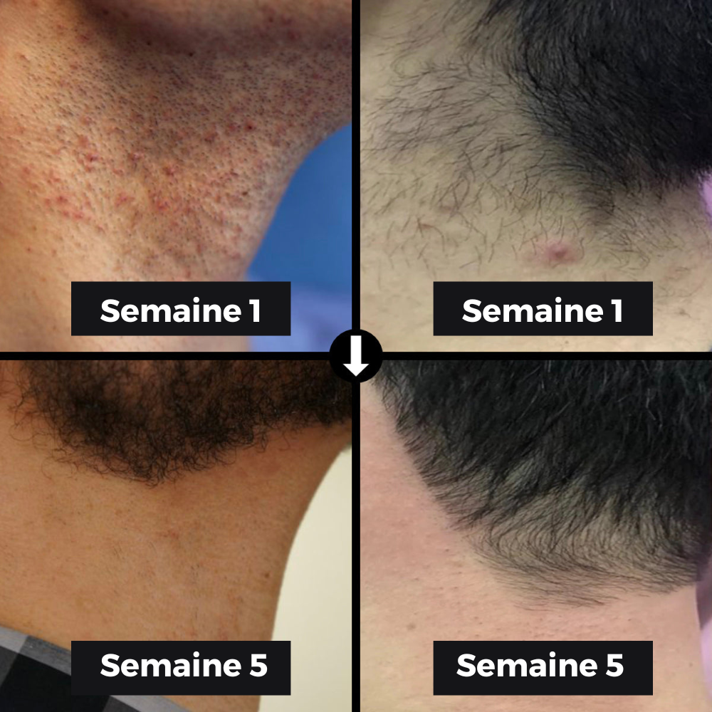 Épilateur IPL pour Hommes - Namido